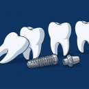Illustration of four dental implants and implant components on a dark blue background.
